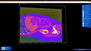 Liver Cyst Revised [upl. by Christianson]