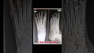 X ray of foot radiology [upl. by Nnadroj993]