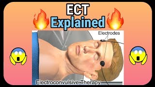 Electroconvulsive therapy ECT explained  How it is performed [upl. by Sidell]