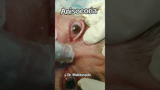 ANISOCORIA medicina seguridad ciencia sabiasque emergency curiosidades tratamientos [upl. by Analla]