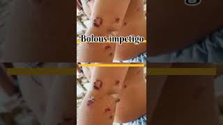 Bolous impetigo Infectious diseases Pediatrics dermatology [upl. by Norvall]