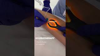 Instant Results with Sclerotherapy for Spider Veins  EDEN AESTHETICS Clinic Dubai [upl. by Michele]