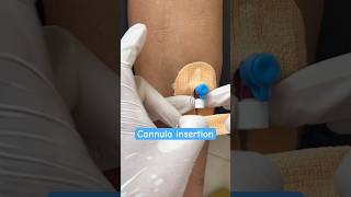 Cannula insertion of male patient nurses cannula shorts neet ytshorts youtubeshorts subscribe [upl. by Eanerb]