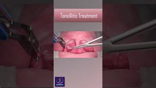 Tonsillitis Treatment With Heat Device tonsillitis [upl. by Namra]