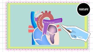 Babies with misshapen hearts singleventricle defects [upl. by Yebloc]