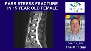 Pars defect of lumbar spine in 15 year old [upl. by Annauqal19]