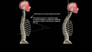 01 KYTests Part 1  Hyperkyphosis in thoracic vertebrae  Side view [upl. by Neva]