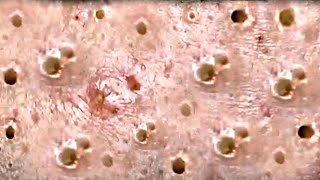 Amazing Blackheads Remover on the Face 003 [upl. by Haletky761]