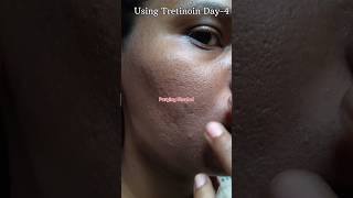 Using Tretinoin 0025 cream Day4 skincare viralvideo youtubeshorts shorts [upl. by Severin]