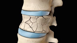 Back Surgery  Vertebroplasty and Kyphoplasty  Nucleus Health [upl. by Merissa]