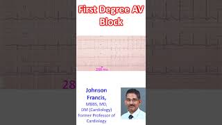 First Degree AV Block [upl. by Warner]