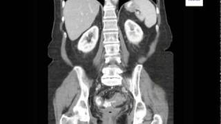 Diverticulitis on CT Scan [upl. by Manly493]