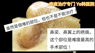 鼻疤痕治疗非常困难，但sl治疗可以提供满足。青春痘疤痕江南整形外科江南皮肤科江南韩医院Ye韩医院 [upl. by Wachtel]