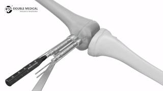 Video Operation of Pediatric Epiphyseal Plate [upl. by Onaivatco]