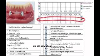 CoverdentureProthesen oder Deckprothesen  HKP abrechnen 14 [upl. by Burley]