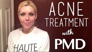 PMD Personal Microderm Review for Acne amp Acne Scars Treatment [upl. by Adnawak]