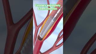 Coronary angioplasty and stent insertion medical shorts animation anatomy [upl. by Itch]