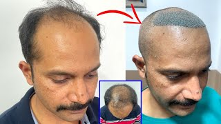 new technology Hair Transplant  Best Hair Transplant Surgery  Before after Hair Transplant [upl. by Uah511]