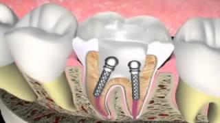 Endodontics Root Canal Therapy [upl. by Pomona]