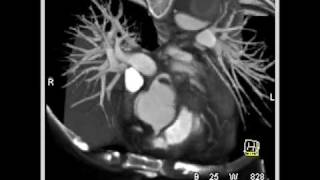 Type B dissection with compression of true lumen [upl. by Nomael]