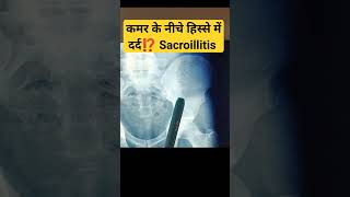 Sacroiliitis Pain in Young 🔥🔥 कमर के नीचे हिस्से में दर्द की समस्या sacroileitis sacroiliacjoint [upl. by Hunley]