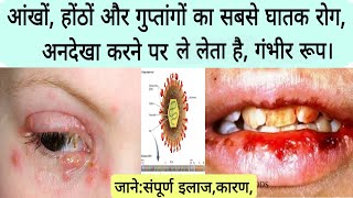 Herpes simplex diseaseintro causessymptomsfull treatment हर्पीज परिसर्प रोग का कारण लक्षणइलाज [upl. by Esille68]