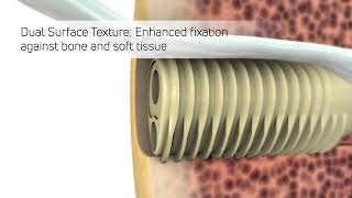 Eclipse™ Tenodesis Implant Animation [upl. by Gurtner]