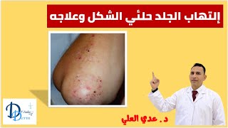 الفقاع الحلئي dermatitis herpetiformis [upl. by Ahsito635]