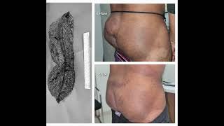 Vascular malformation  Sclerotherapy amp Debulking [upl. by Haldis]