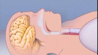 What Is Sleep Apnea [upl. by Cobbie]