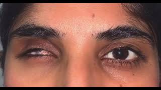 Life like prosthetic eye Artificial eye movements  Dr Jibran [upl. by Amaleta30]