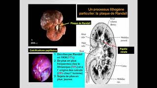 FMPM MOOCs  Lithiase urinaire  Pr Moudouni [upl. by Vera]