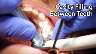 Dentist Filling A Cavity Between Teeth [upl. by Akcemat]