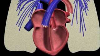 PFO closure animation [upl. by Arza172]