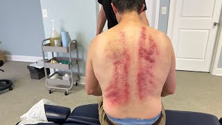 Dark Purple Comes Out Of His Skin 😱 No Wonder His Back Spasms 😥 Deep Cracks amp INTENSE Elbow MASSAGE [upl. by Prudie]