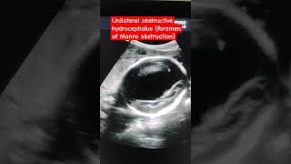 Foramen of Monro obstruction Unilateral hydrocephalus Third and fourth ventricle normal [upl. by Chu]