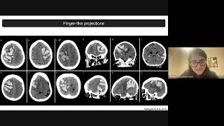 Angiopatia Amiloide Cerebral AVC hCemorrágico e HSA Hemorragia subaracnoidea [upl. by Anah]