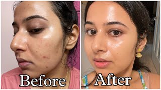 Simple Tretinoin Night Skincare Routine for Acne free Glowing Skin skincare skincareroutine [upl. by Rramal]