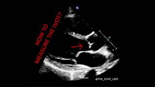 ECHOCARDIOGRAPHY How to measure the LVOT [upl. by Ortiz]