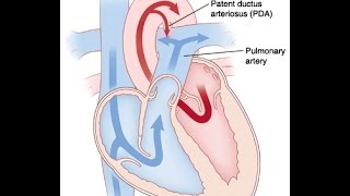 Patent Ductus Arteriosus [upl. by Ttemme]