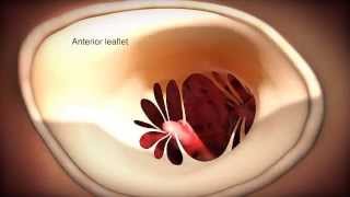 Minimally Invasive Robotic Mitral Valve Repair Animation [upl. by Aia]