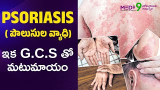 Psoriasis causes amp Treatment Telugu  Skin Infection skincare psoriasis [upl. by Wilkinson260]