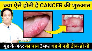 मुंह के अंदर सफ़ेद लाल धब्बें हो तो क्या ऐसे होती है cancer की शुरुआत [upl. by Fahy]