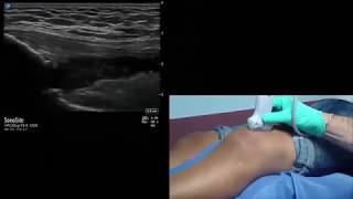 StepbyStep Ultrasound Guided IntraArticular Knee AspirationInjection Procedure [upl. by Ailis]