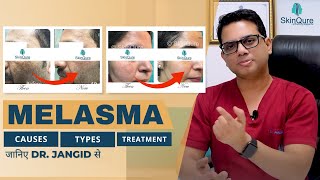 All About Melasma  Causes Types and Treatment options  जानिए Dr Jangid से हिंदी में  SkinQure [upl. by Ninaj]