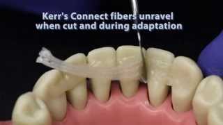 Ribbond compared to other dental fiber reinforcement materials [upl. by Aninat]