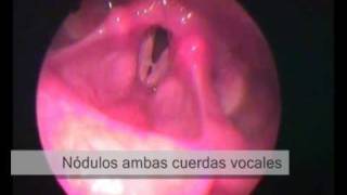 Lesiones en cuerdas vocales y laringe [upl. by Charles182]