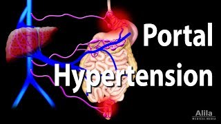 Portal Hypertension Animation [upl. by Kristie]