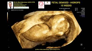 FETAL Demised 15 weeks HIDROPS fetalis [upl. by Ratib768]