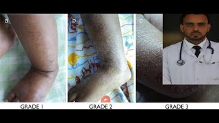 Dermatosis in children with edematous malnutrition  causes grades and treatment [upl. by Ennail402]